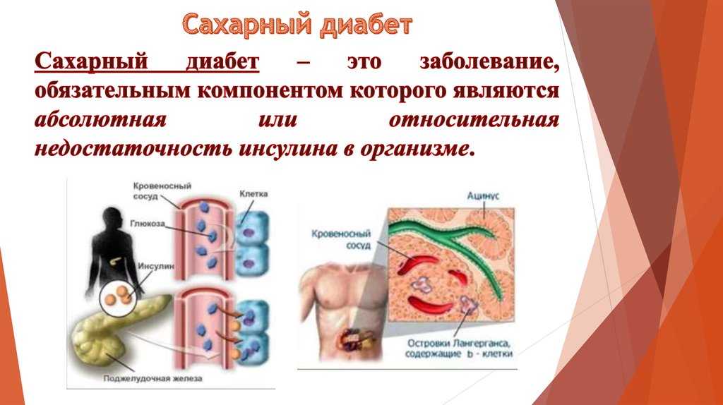 Сахарный диабет презентация по патологии