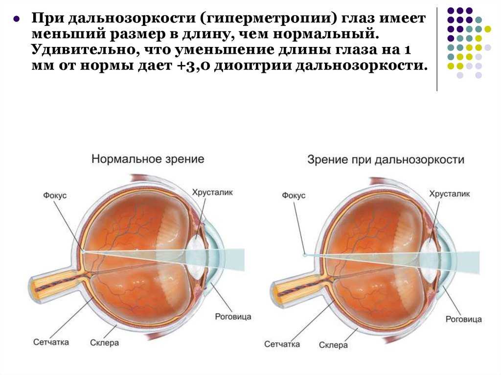 При дальнозоркости изображение формируется